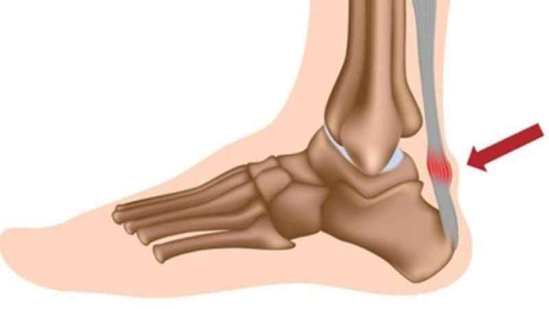 Chấn thương gót chân khi đá bóng là gì?